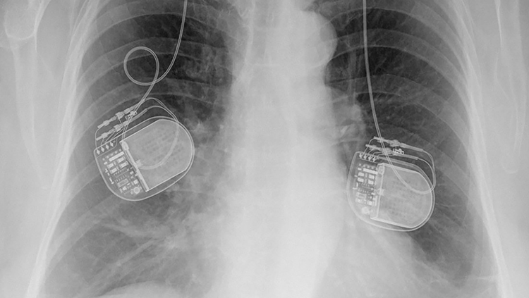Black-and-white X-ray of chest with power pack inside
