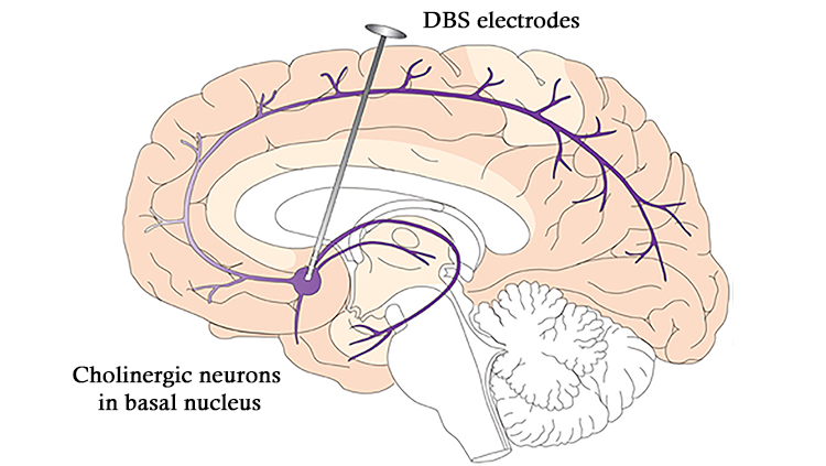 Drawing of brain corrected