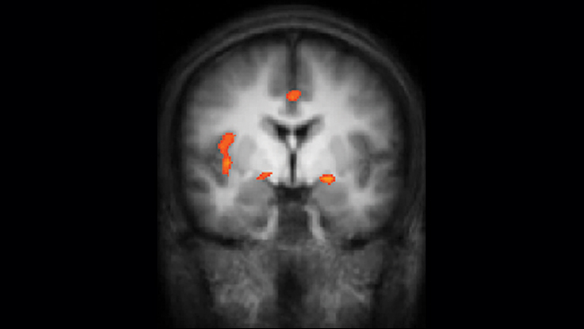 Brain scan highlighting amygdala function