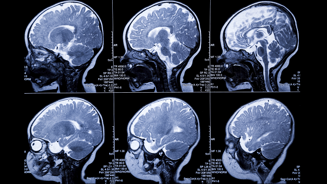 MRI scans of an infant's brain through different developmental stages. 