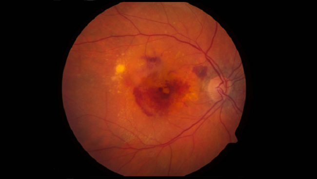 This photograph shows an eye affected by a severe form of macular degeneration, in which blood vessels leak fluid and blood under the retina.