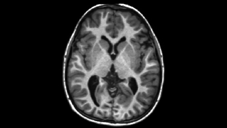image of the brain with gray matter
