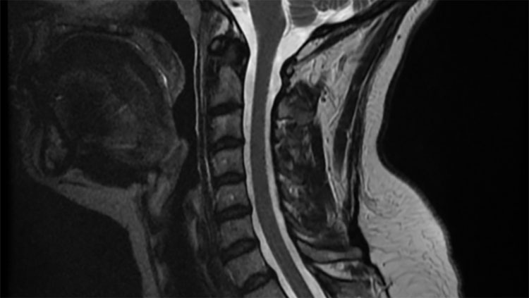 Spinal cord x-ray