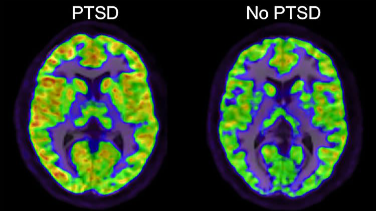 Image of brain with and without PTSD