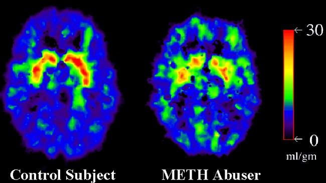 Brain scans from a methamphetamine abuser