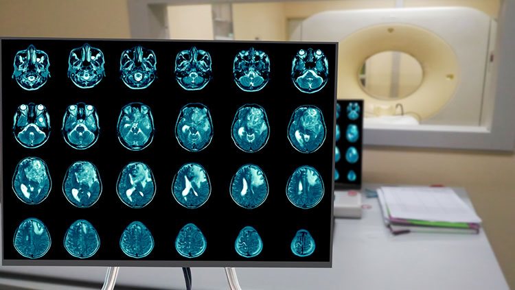 Brain Tumor Scans