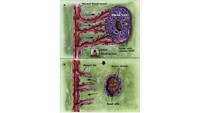Two illustrations: one of a tumor feed by blood vessels and another of a shrinking tumor cut off from a blood supply