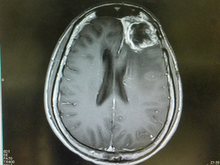 scan of brain with glioblastoma tumor