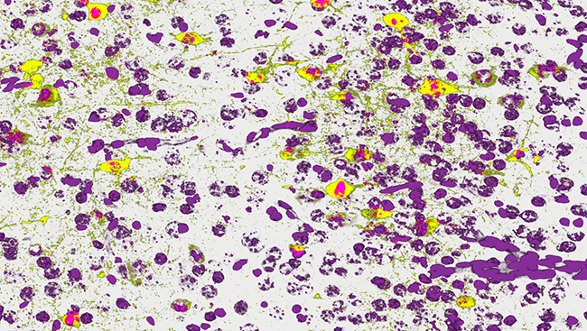 The image above shows inhibitory neurons (yellow) and other neurons (purple) in the cerebral cortex of a mouse with a condition similar to Down syndrome. 