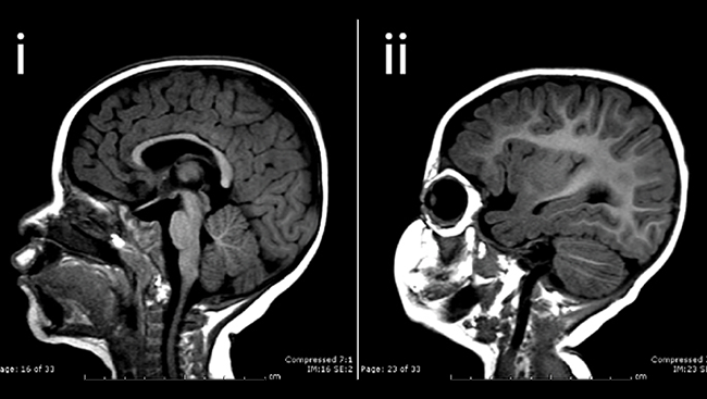 Zika has been connected with birth defects like microcephaly. Children born with microcephaly (pictured on the right, compared to a healthy baby brain on the left) often have developmental delays in speech and motor skills, as well as more severe effects in some cases.