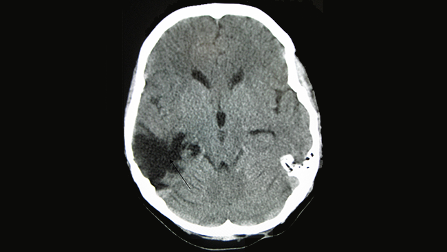 A CT scan of an injured brain. The arrow indicates where the damage occurred, in the empty space within the brain.