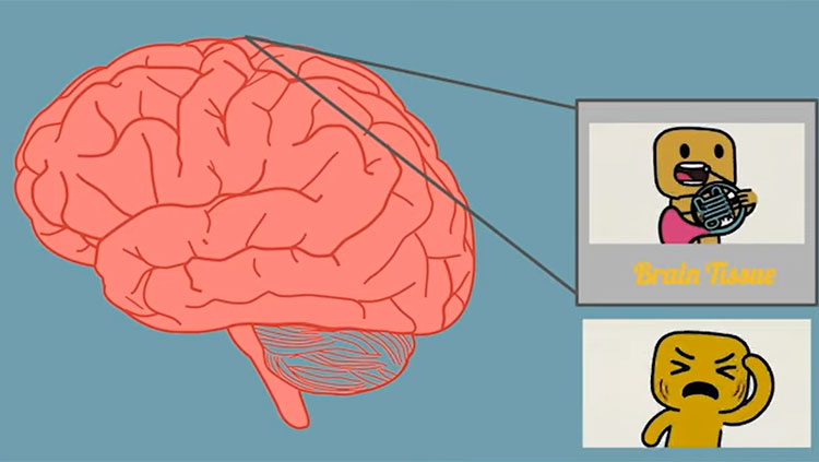 Concussion brain thumbnail