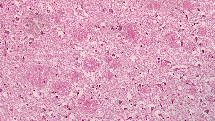 image of prions