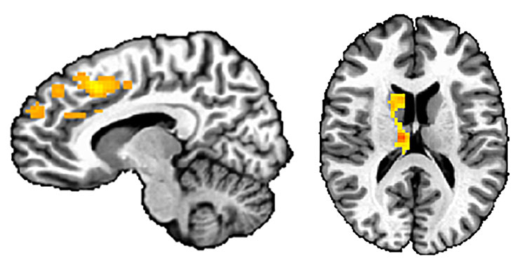 MRI of child's brain
