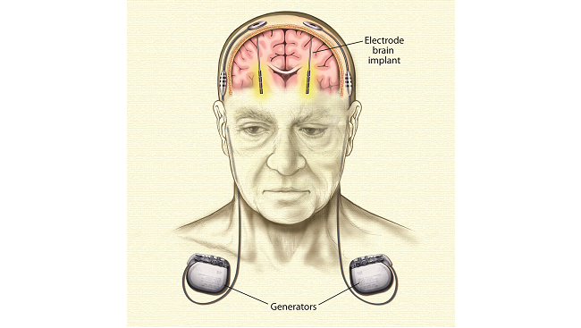 Illustration of electrodes implanted into the brain