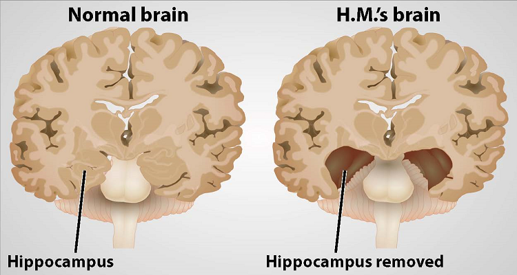 Image of HM's brain compared to a normal brain