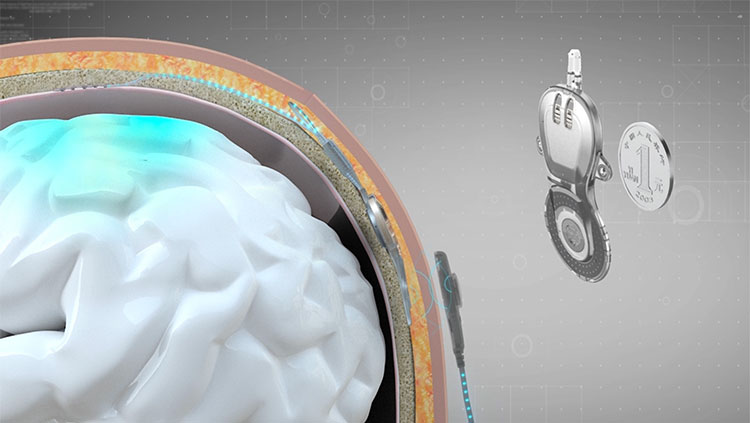 An illustration of the NEO epidural BCI