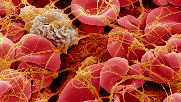 SEM of blood corpuscles in clot
