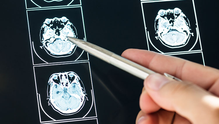 hand holding a pen points to scans of a brain