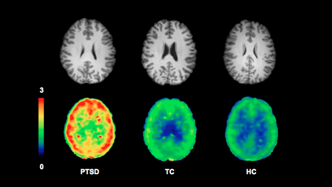 In this image, brightness corresponds to the number of receptors, highlighting the difference between the PTSD brain on the left from the two control brains. 