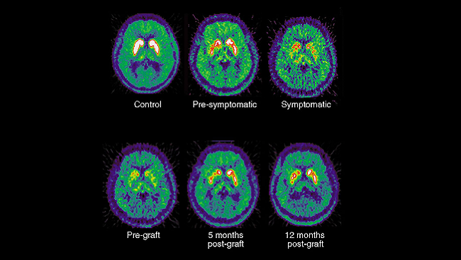 Images from positron emission tomography (PET) reveal the disrupted dopamine signaling in the brains of Parkinson’s patients compared to healthy subjects.