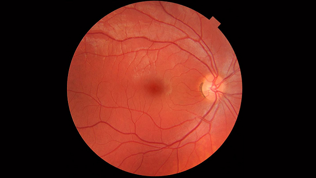 In this photograph of the interior of a healthy human eye, the macula can be seen in the center of the image.